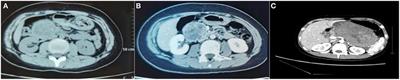 Diagnosis and treatment of solid pseudopapillary neoplasm of the pancreas in children: A report of 18 cases